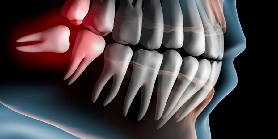 Pourquoi avons-nous des dents de sagesse ?